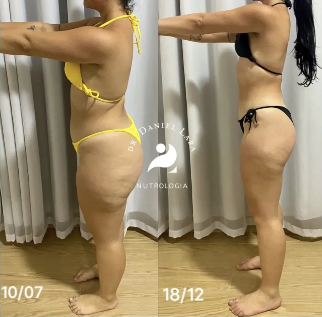 Resultado de paciente após acompanhamento nutrológico — antes e depois